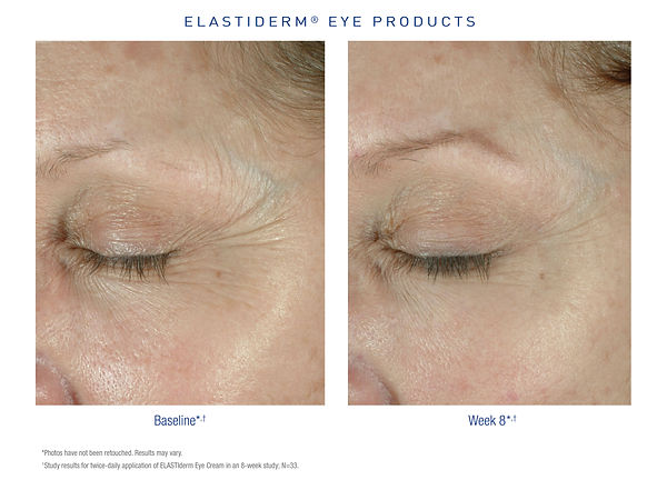 ElastiDerm Before and After