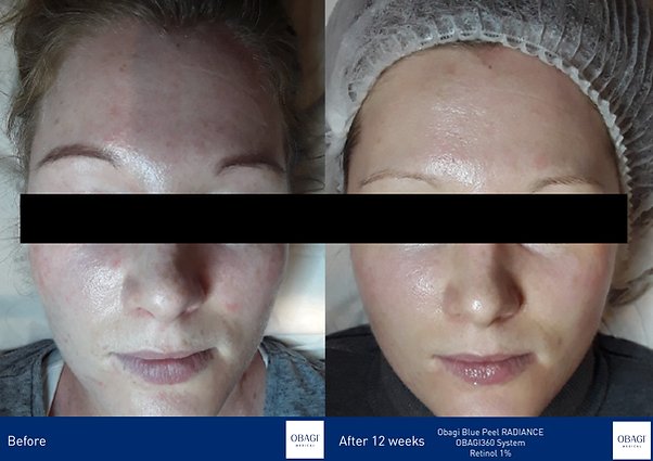 Obagi Blue Peel Before and After