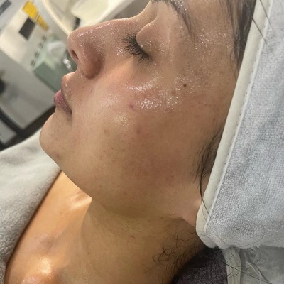 Bespoke-Skin-Peels-at-Divine-Beauty-Salon-in-Hertfordshire